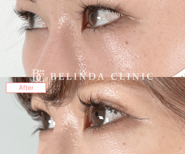 二重整形埋没法症例No501