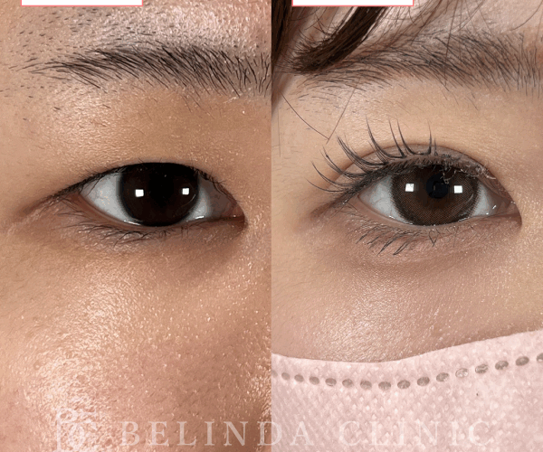 二重整形埋没法症例No547