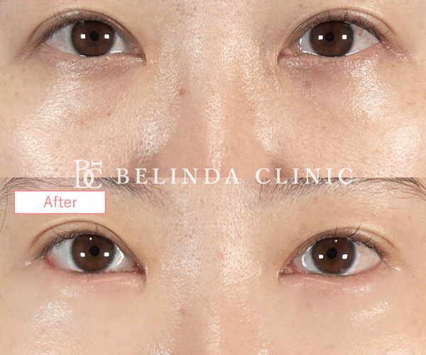 切らないクマ取り・裏ハムラ法症例No640