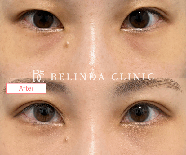 二重整形埋没法症例No6644