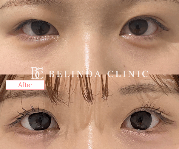 二重整形埋没法症例No7534