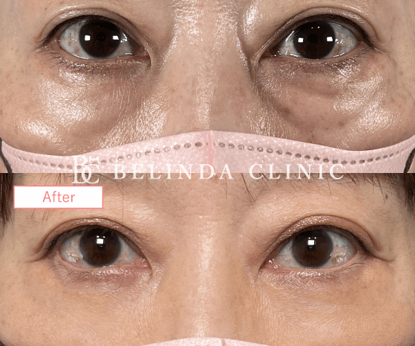 切らないクマ取り・裏ハムラ法症例No754