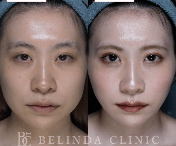 小顔脂肪吸引症例No8085