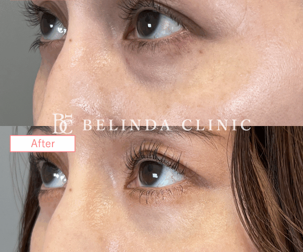 切らないクマ取りたるみ取り症例No8463