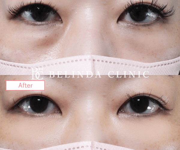 切らないクマ取りたるみ取り症例No857