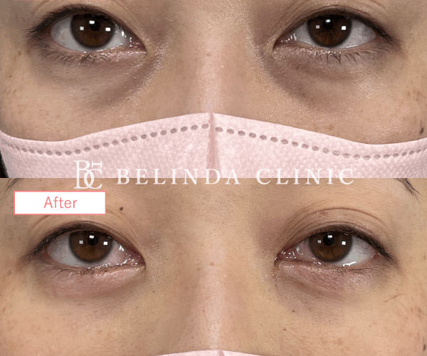 切らないクマ取りたるみ取り症例No976