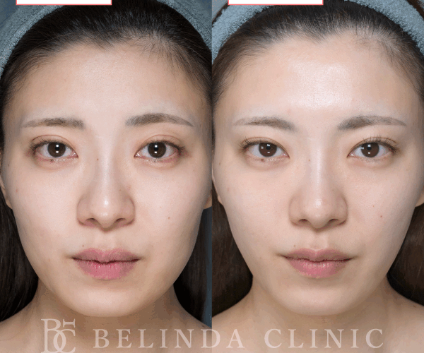 小顔脂肪吸引症例NoCK加藤