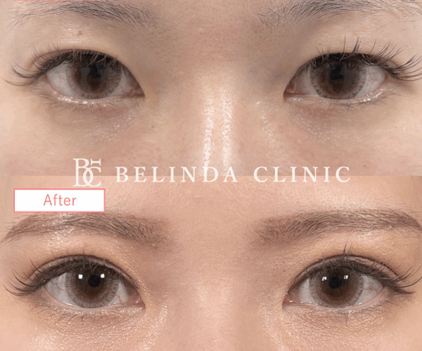 二重整形埋没法症例No137