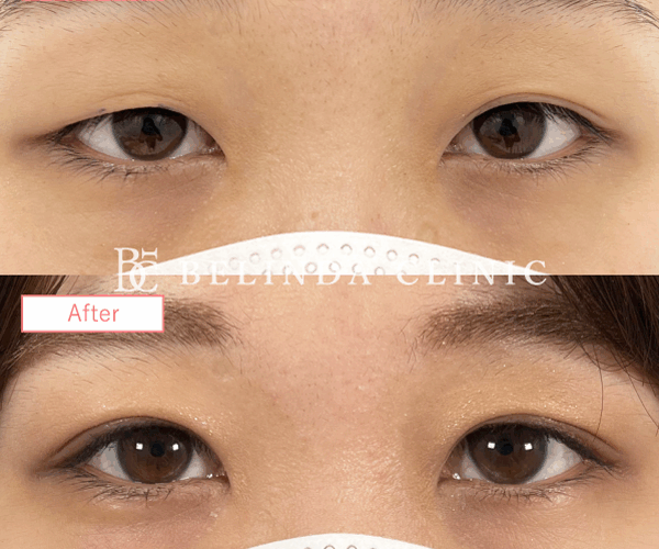 二重整形埋没法症例No244