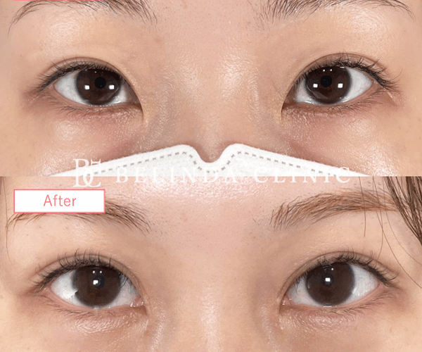 二重整形埋没法症例No385