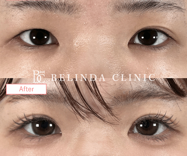 二重整形埋没法症例No547