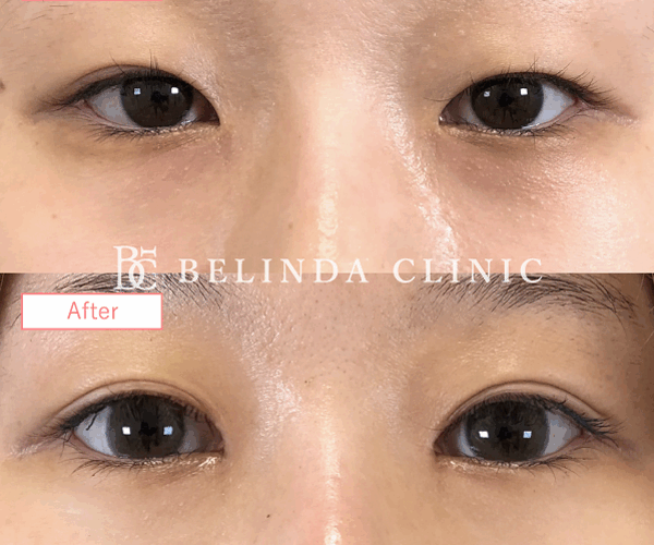 二重整形埋没法症例No5552