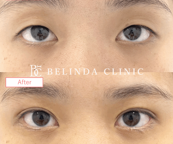 二重整形埋没法症例 No6578