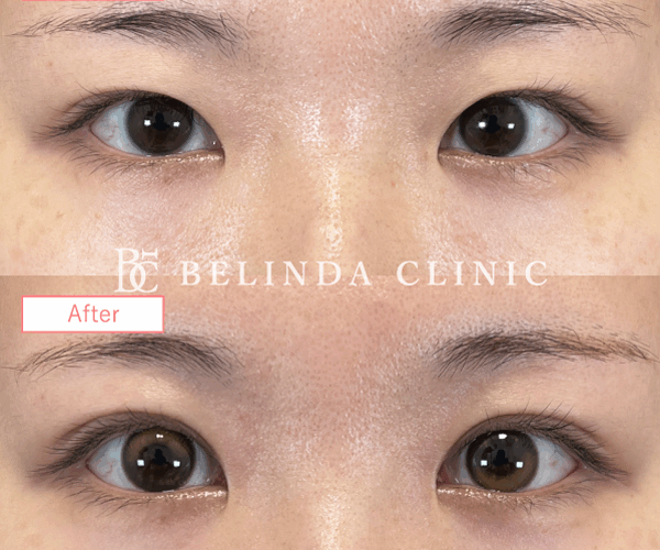 二重整形埋没法症例No8289