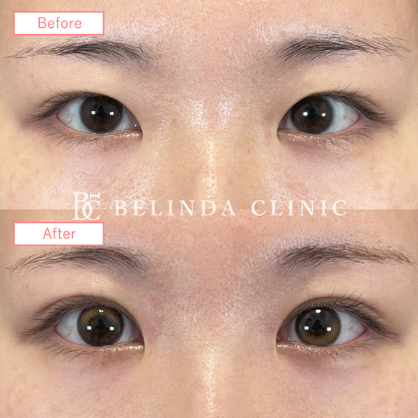 目上切開法ビフォーアフターcase11