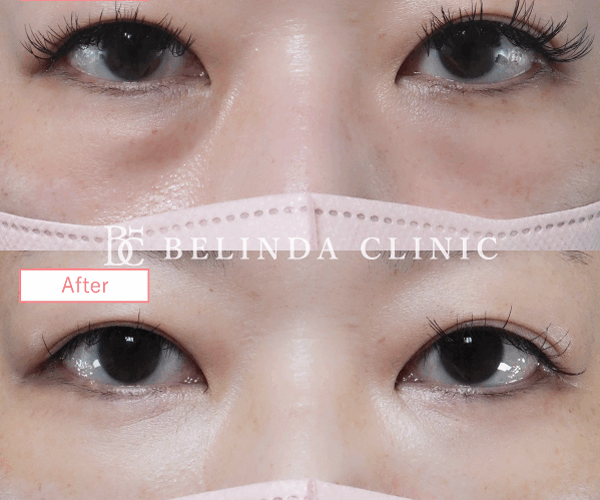 切らないクマ取りたるみ取り症例No857