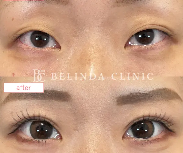 二重埋没法No8847