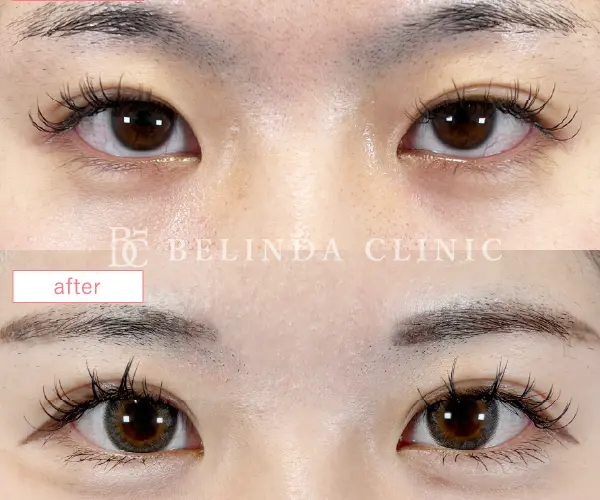 二重埋没法No8848