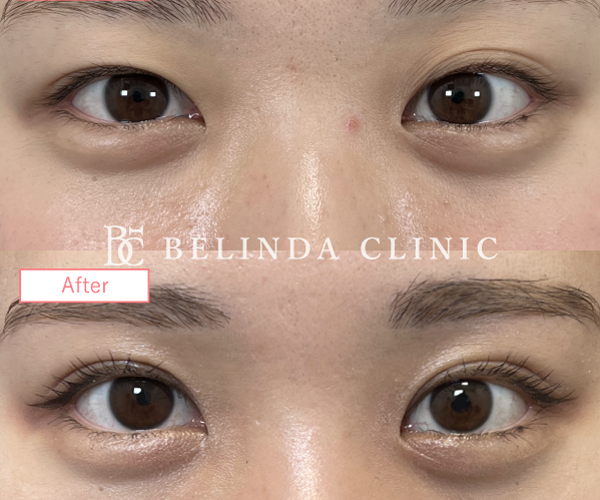 二重整形埋没法症例No8015