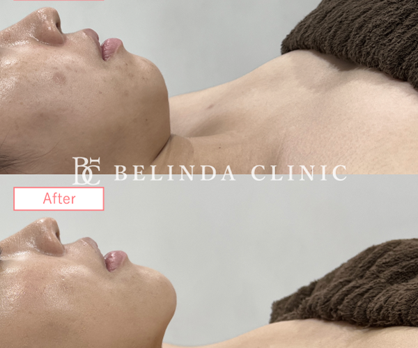 糸リフト症例No8819