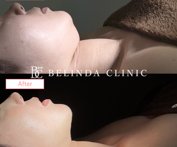 小顔脂肪吸引症例No89