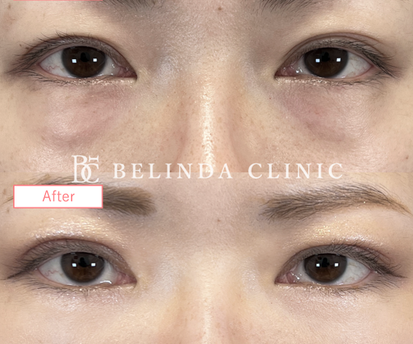 切らないクマ取り・裏ハムラ法症例No9154